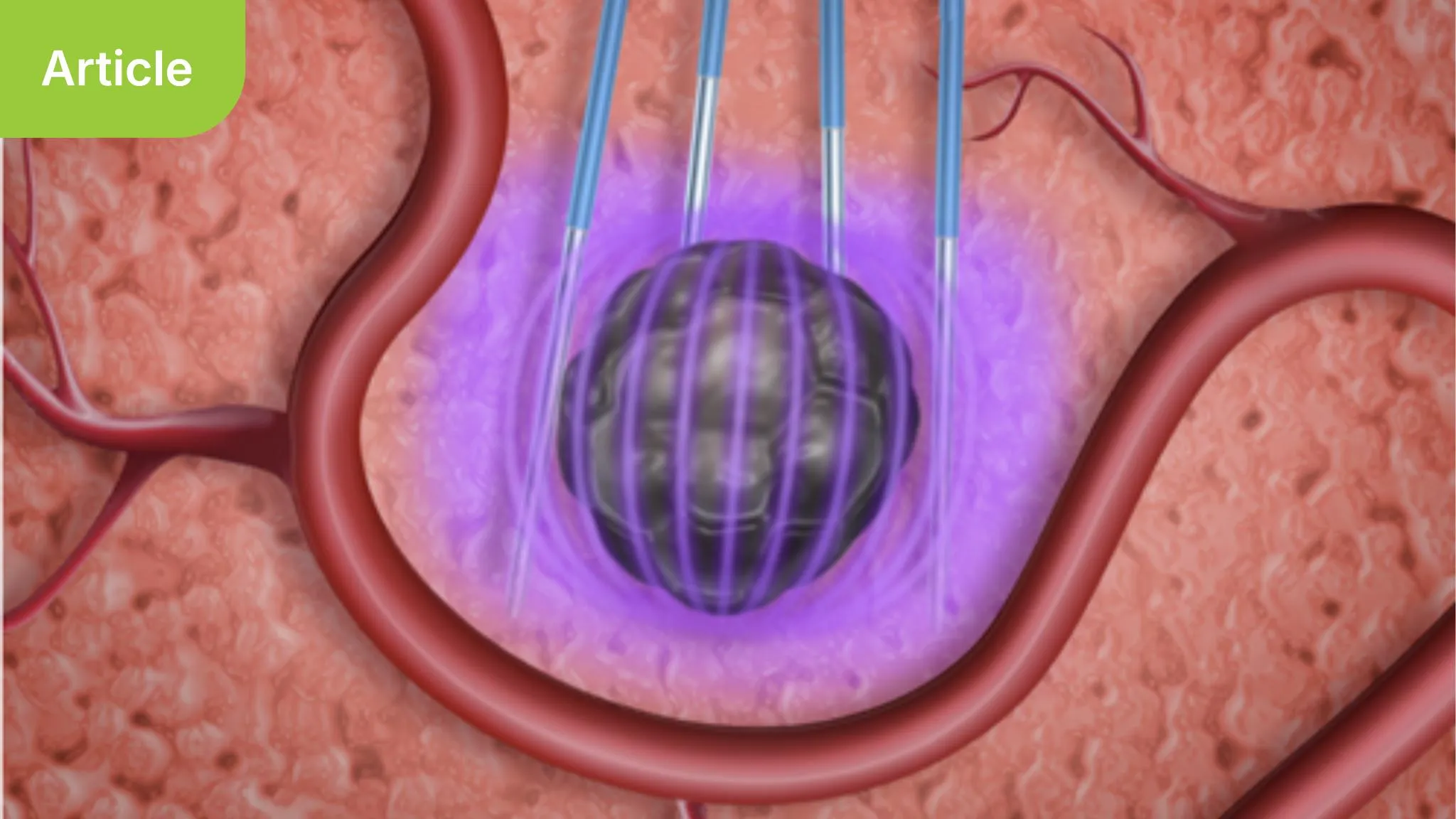 The Expanding Frontiers of Ablation Therapies